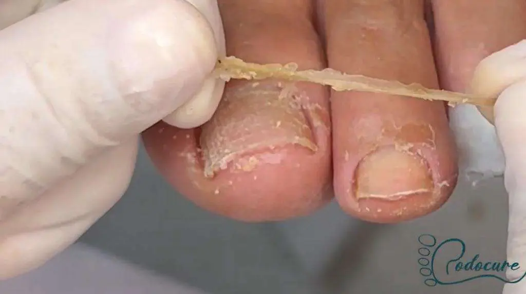 Aplicação de peeling químico Podocure